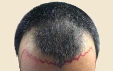 Hair before hair transplantation