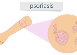 Psoriasis