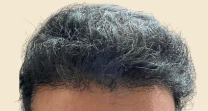 Result after hair Transplantation