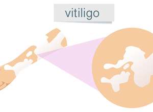 Vitiligo