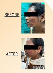 Before and after image of a woman who has undergone chemical peel treatment for acne by Dr. Sneha Kovi