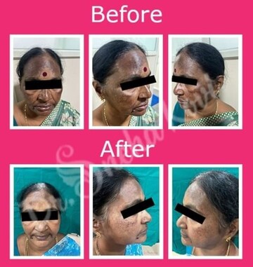 Before and after image of a person who has undergone hyperpigmentation treatment by Dr. Sneha Kovi