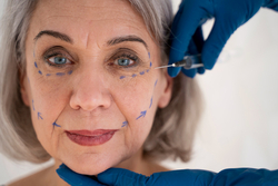 A woman undergoing thread lifts procedure