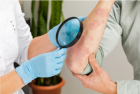 A person undergoing psoriasis treatment