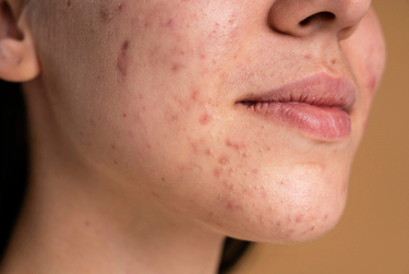 A woman having acne problem