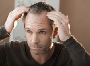 Male Pattern Baldness