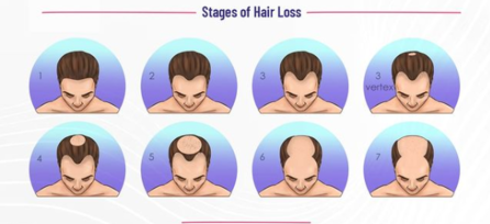 7 Stages of Balding