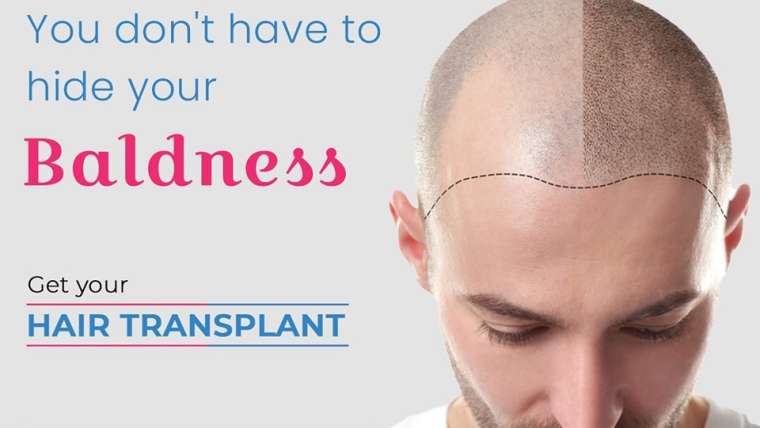 Top Benefits of Hair Transplant Surgery
