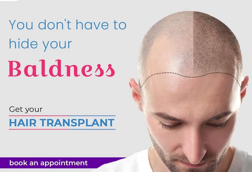 Top Benefits of Hair Transplant Surgery