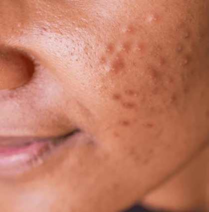 Adult Acne: Why Are You Still Getting Pimples After 25?